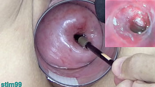Cougar Milf Cervix Play with Endoscope Asian Online camera into Uterus