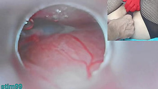 Thai Insemination with Sperm into Uterus and Endoscope Online cam by Cervix to watch inside womb Uncensored