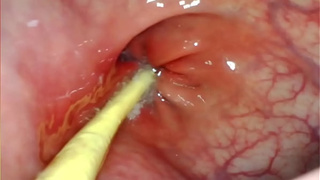 EXTREME ANAL SELF PERSPECTIVE. WEB-CAM INSIDE HER BUTT-HOLE AS I POUND HER WITH MY GIGANTIC ROD AND SPUNK DEEP INSIDE