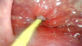 EXTREME ANAL POINT OF VIEW. WEB CAMERA INSIDE HER BUTTHOLE AS I POUND HER WITH MY BIG MEAT AND SPERM DEEP INSIDE