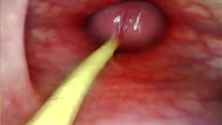 EXTREME ANAL POINT OF VIEW. WEBCAM INSIDE HER BUTTHOLE AS I POUND HER WITH MY GIGANTIC COCK AND SPUNK DEEP INSIDE