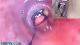 Old Woman Peehole Endoscope Web-Cam in Bladder with Balls