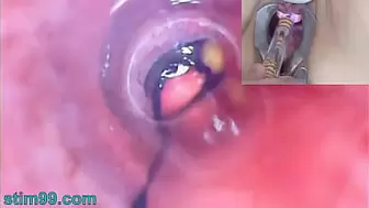 Old Woman Peehole Endoscope Web-Cam in Bladder with Balls