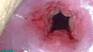 Uncensored Chinese Cervix Stretching and Uterus Dilation with Penetration